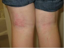 Las complicaciones atopicheskogo de la dermatitis